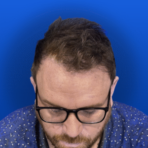 Jim, 31, man, Micro PUE® hair transplant Chicago, hairline, 3,018 grafts, before and after photos