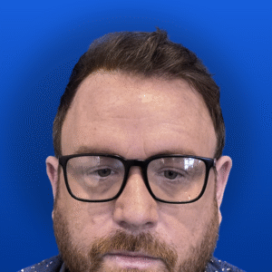 Jim, 31, man, Micro PUE® hair transplant Chicago, hairline, 3,018 grafts, before and after photos