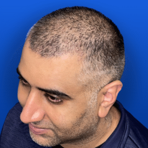 Dr Vinay Hair Transplant