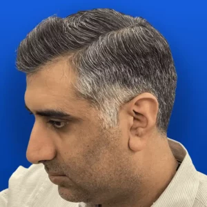 Dr Vinay Hair Transplant